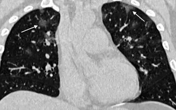 "سی تی اسکن" روش تشخیص کروناویروس است نه غربالگری و چکاپ
