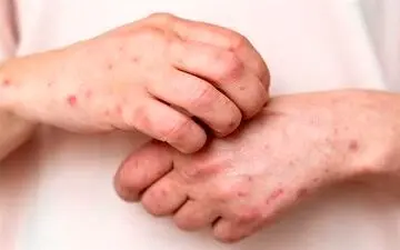 وضعیت بروز و شیوع آبله مرغان در کشور چگونه است؟

