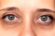 اگر تیرگی دور چشم دارید، این روش‌ها را فقط ۳ روز امتحان کنید