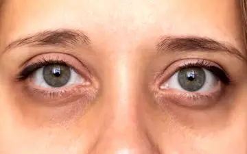 اگر تیرگی دور چشم دارید، این روش‌ها را فقط ۳ روز امتحان کنید