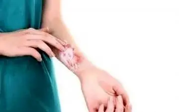  برای درمان سوختگی از این موارد استفاده نکنید