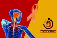 ابتلای ۱۲۰ هزار نفر به بیماری ام اس در کشور