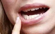 گوشه‌های دهان تان ترک می‌خورد؟ دچار کمبود این ویتامین‌ها شده اید