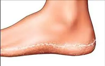 راه های رهایی از ترک های پا