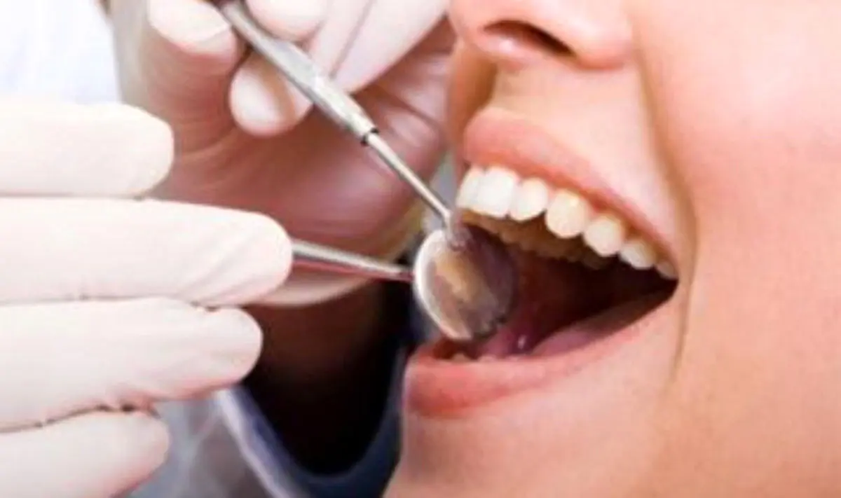 مزایا و معایب لمنیت و کامپوزیت دندان چیست؟