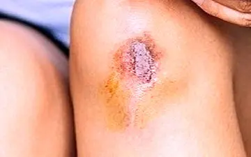 دلایل بروز عفونت سوختگی