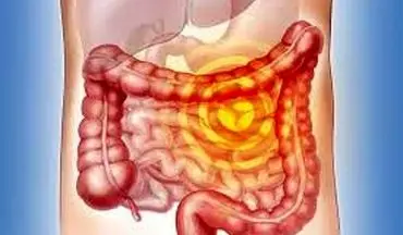تشخیص به موقع سرطان روده بزرگ