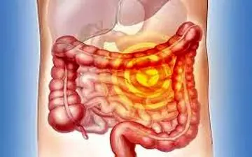 تشخیص به موقع سرطان روده بزرگ