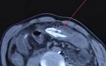 علت عجیب شکم درد شدید مرد میانسال! 