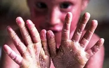 این بیماری درمان دائمی ندارد