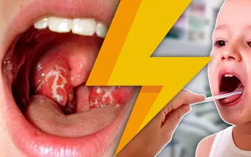 علائم ورم لوزه چیست؟