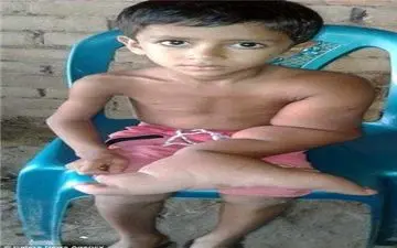 عکس/ دست عجیب پسر 5 ساله بنگلادشی