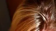 دلایل چرب شدن موی سر و راههای کاهش آن