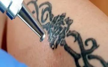 از انجام تتو پشیمان شده ای؟| توصیه هایی برای پاک کردن تتو

