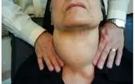 آیا التهاب تیروئید بعد از زایمان می‌تواند باعث افسردگی شود؟