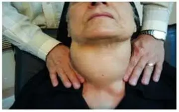 آیا التهاب تیروئید بعد از زایمان می‌تواند باعث افسردگی شود؟