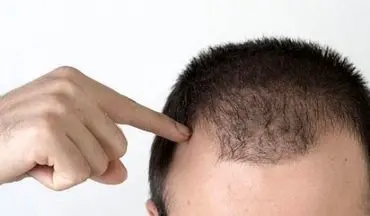 ریزش موهایتان را با این روش ها متوقف کنید!