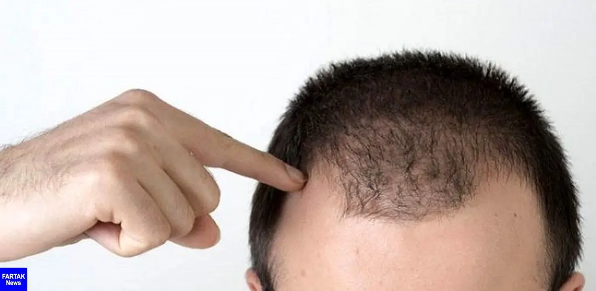 ریزش موهایتان را با این روش ها متوقف کنید!