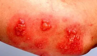 اگر بالای ۵۰ سال دارید، این واکسن جانتان را نجات می‌دهد