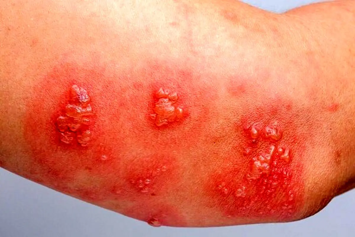 اگر بالای ۵۰ سال دارید، این واکسن جانتان را نجات می‌دهد