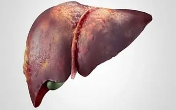 بیماری کبد| 7 علائم ابتلا به بیماری‌های کبد را بشناسید