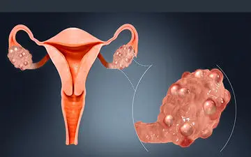 آیا چیزی به عنوان  کیست رحم داریم؟