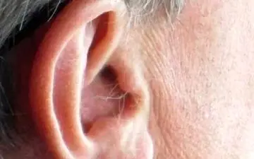 ارتباط شگفت‌انگیز بین موی گوش و حمله قلبی!
