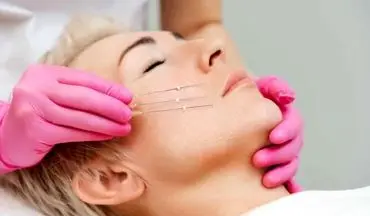 لیفت با نخ چیست و برای چه کسانی مناسب است؟