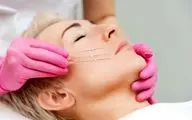 لیفت با نخ چیست و برای چه کسانی مناسب است؟