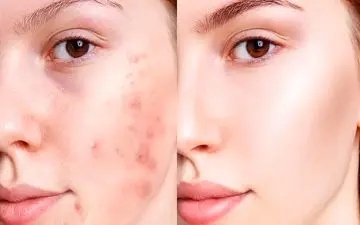 پنج ماده‌ای که به مبارزه با آکنه کمک می‌کند