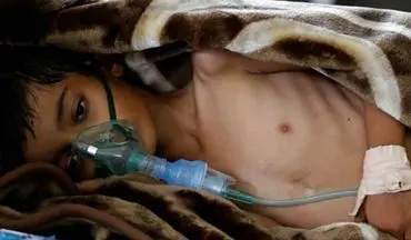 وزارت بهداشت: بیش از 2 هزار یمنی بر اثر وبا جان خود را از دست داده‌اند