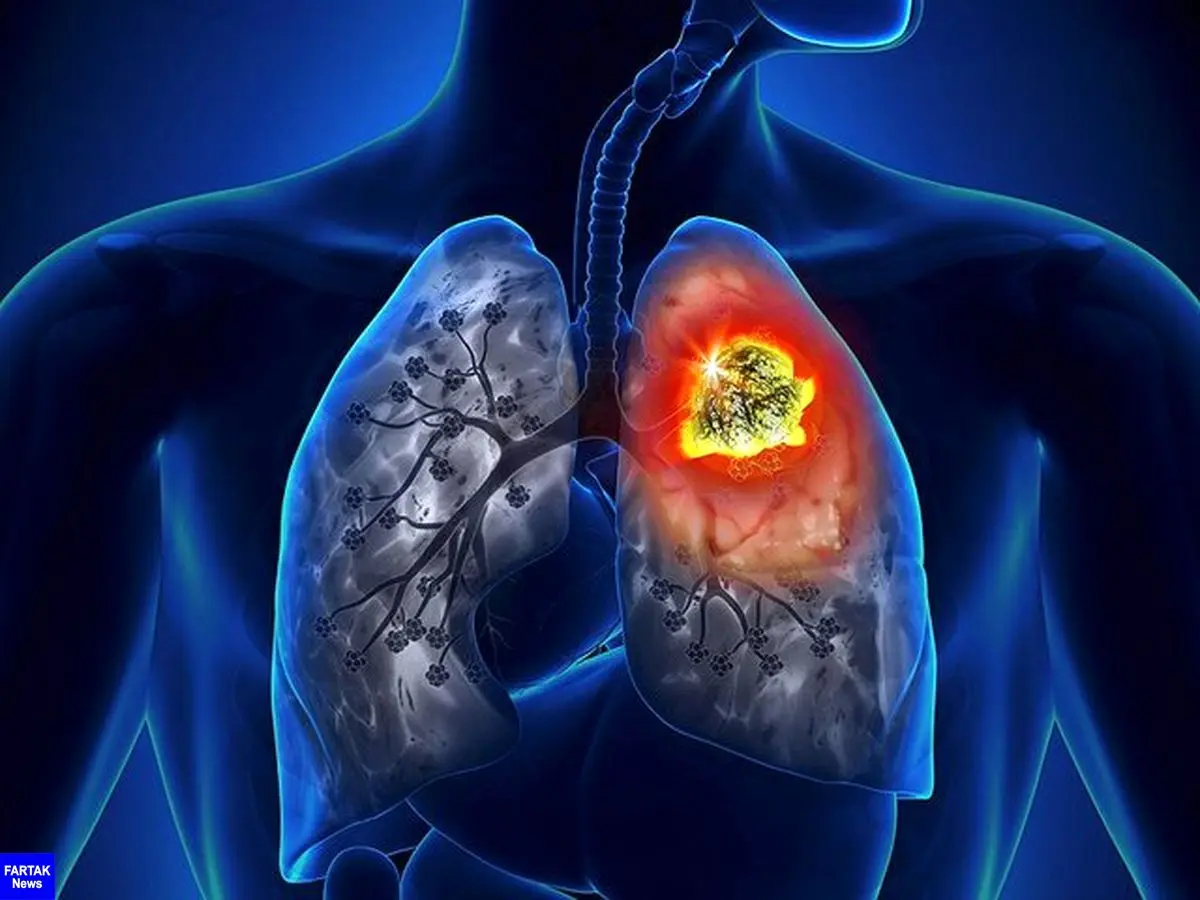 
کاهش مرگ‌ومیر ناشی از سرطان ریه با مدل‌های جدید پیش‌بینی
