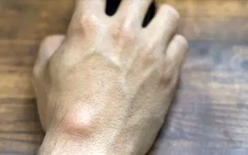 علت‌های برآمدگی‌های سفت زیر پوست