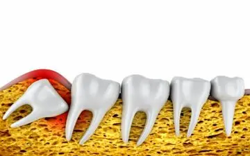 رفع مشکلات رایج دندان عقل