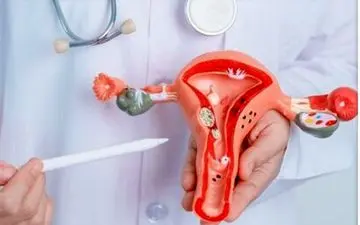 درباره آندومتریوز چه می‌دانید؟