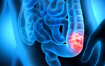 این خوراکی‌ها از ابتلا به سرطان روده جلوگیری می کنند

