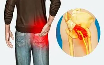 درمان خانگی سیاتیک!