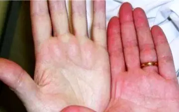 پُرخونی چه نشانه هایی دارد؟