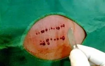 هر آنچه که لازم است درمورد حجامت بدانید!