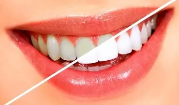 سفید کردن دندان در کمتر از سه دقیقه!