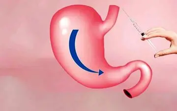 بوتاکس معده راهی برای مرگ زودرس! 