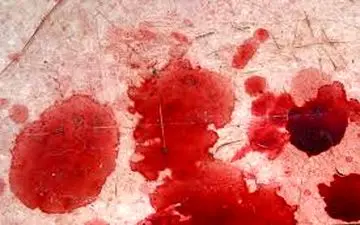 چه کسانی مستعد لخته شد خون هستند؟