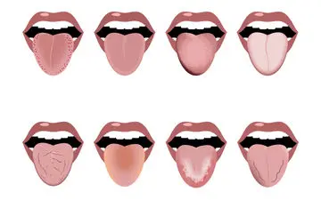 
زبان و بیماری‌های آن
