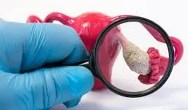  کیست‌های تخمدانی را بعنوان جدی ترین عامل ناباروری جدی بگیرید!