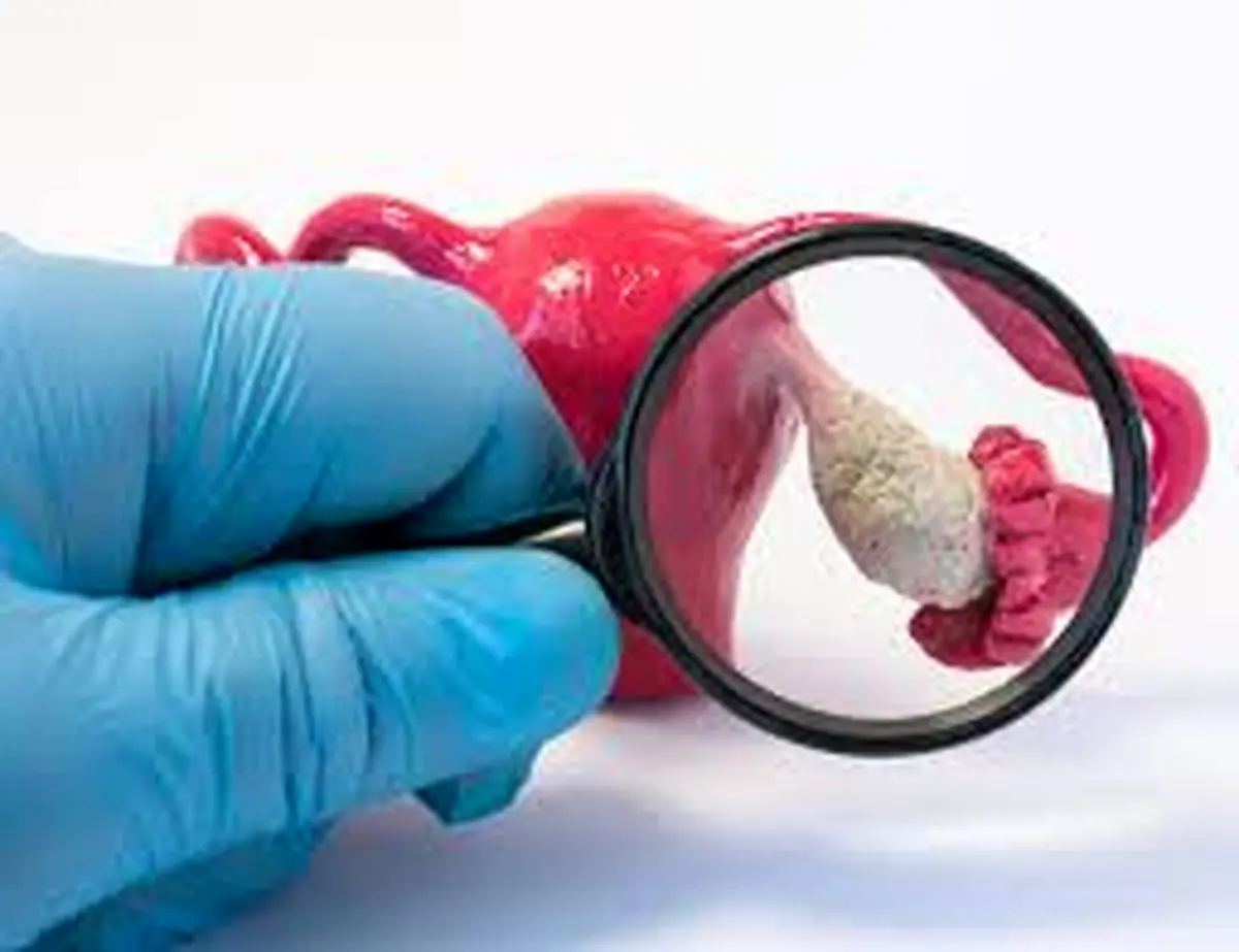  کیست‌های تخمدانی را بعنوان جدی ترین عامل ناباروری جدی بگیرید!