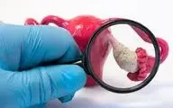  کیست‌های تخمدانی را بعنوان جدی ترین عامل ناباروری جدی بگیرید!