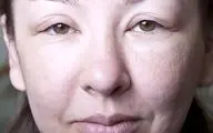 مراقب ورم صورت باشید: از دلایل تا درمان‌های فوری و خانگی