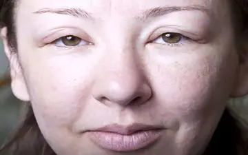 مراقب ورم صورت باشید: از دلایل تا درمان‌های فوری و خانگی