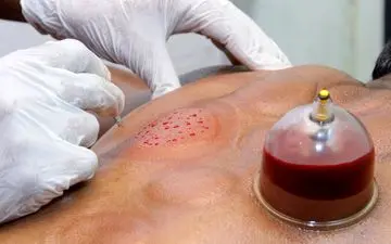 این بیماری‌ها را با حجامت درمان کنید/ بهار؛ بهترین فصل حجامت است؟