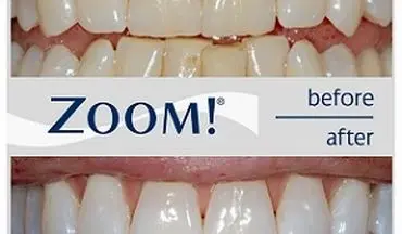  بلیچینگ روشی ایمن برای سفید کردن دندان است؟